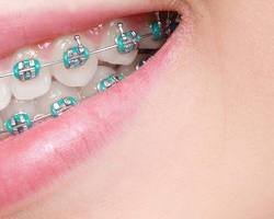 Read more about the article Dental Implants, Braces & More – Comprehensive Care at Cosme-Dent Dental Care Ballygunge